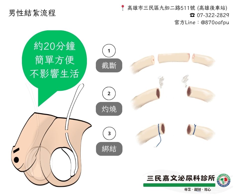 無痛舒眠結紮、包皮、菜花手術【九如三民分院】的第2張圖片